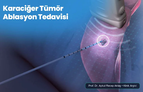 Karaciğer Tümör Ablasyon Tedavisi